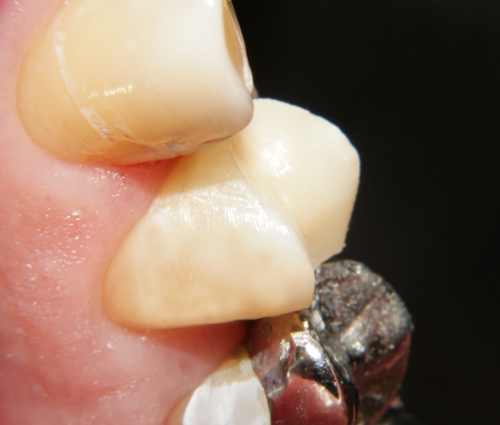 Зъбна реставрация на премоларен зъб