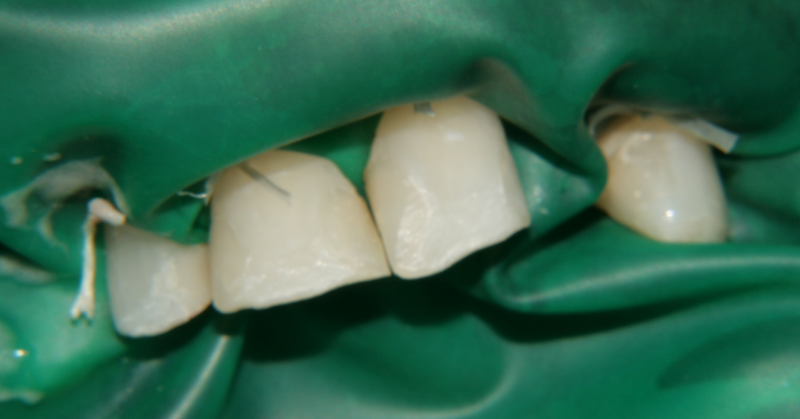 Изолация на зъбите с кофердам