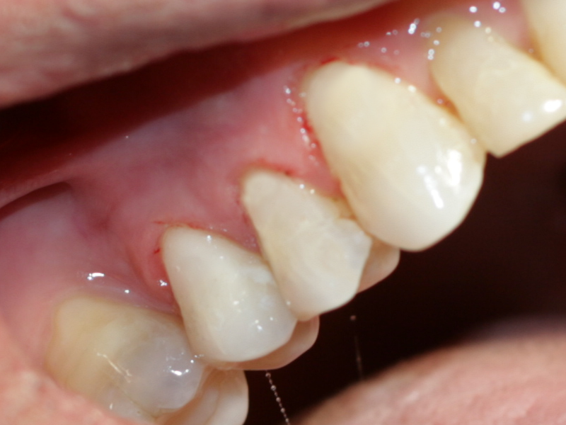 Готовите зъбни реставрации